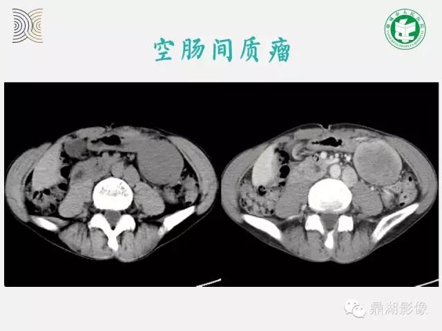 【病例】小肠胃肠道间质瘤1例CT影像表现
