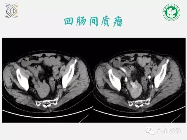 【病例】小肠胃肠道间质瘤1例CT影像表现
