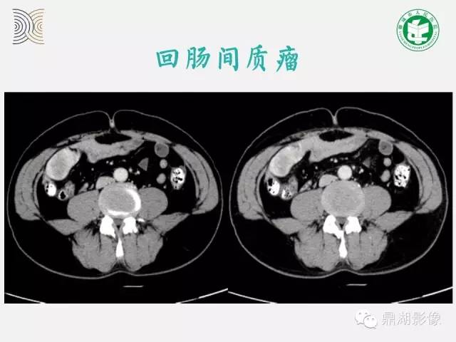 【病例】小肠胃肠道间质瘤1例CT影像表现