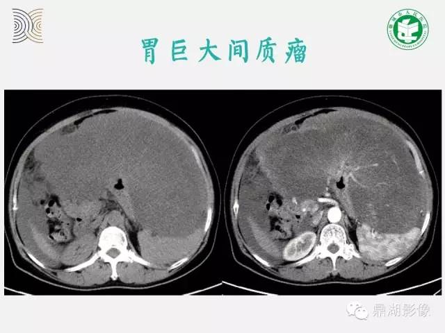 【病例】小肠胃肠道间质瘤1例CT影像表现