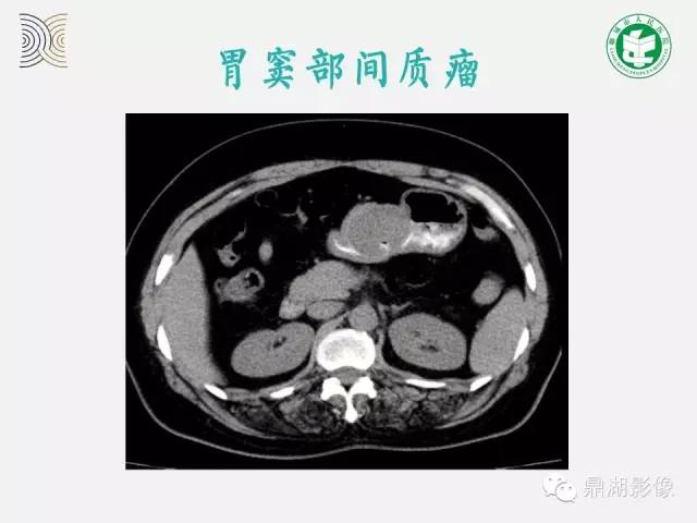 【病例】小肠胃肠道间质瘤1例CT影像表现