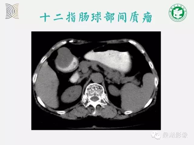 【病例】小肠胃肠道间质瘤1例CT影像表现