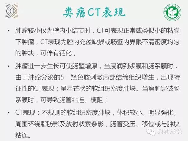 【病例】小肠胃肠道间质瘤1例CT影像表现
