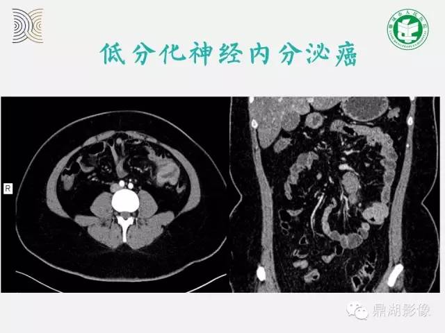 【病例】小肠胃肠道间质瘤1例CT影像表现