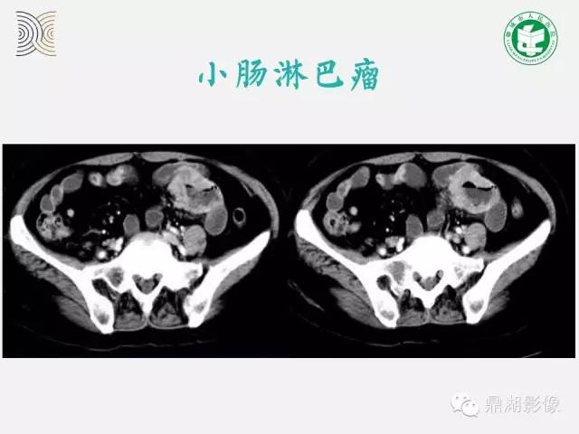 【病例】小肠胃肠道间质瘤1例CT影像表现