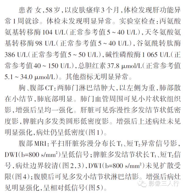 【病例】肝脏结节病一例影像表现 【病例】肝脏结节病一例影像表现