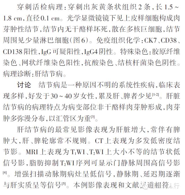 【病例】肝脏结节病一例影像表现 【病例】肝脏结节病一例影像表现