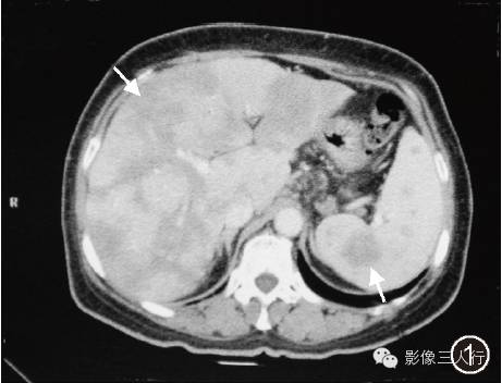 【病例】肝脏结节病一例影像表现 【病例】肝脏结节病一例影像表现