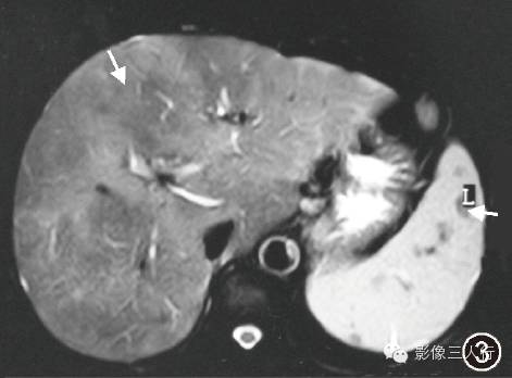 【病例】肝脏结节病一例影像表现 【病例】肝脏结节病一例影像表现