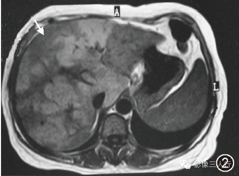 【病例】肝脏结节病一例影像表现 【病例】肝脏结节病一例影像表现