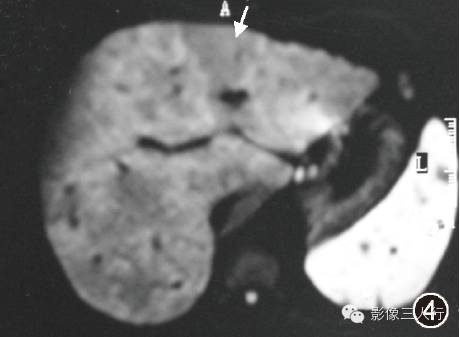 【病例】肝脏结节病一例影像表现 【病例】肝脏结节病一例影像表现