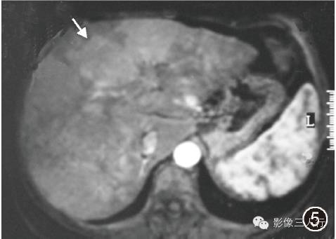 【病例】肝脏结节病一例影像表现 【病例】肝脏结节病一例影像表现