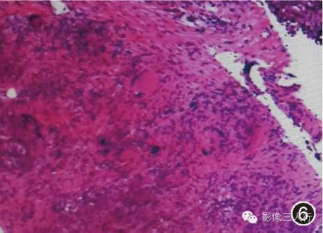 【病例】肝脏结节病一例影像表现 【病例】肝脏结节病一例影像表现