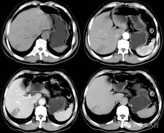 肝脏炎性假瘤 Inflammatory  Pseudotumor，IPT