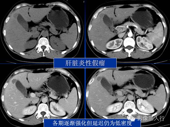 肝脏炎性假瘤 Inflammatory  Pseudotumor，IPT