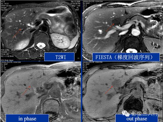 肝脏炎性假瘤 Inflammatory  Pseudotumor，IPT