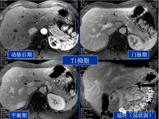 肝脏炎性假瘤 Inflammatory  Pseudotumor，IPT