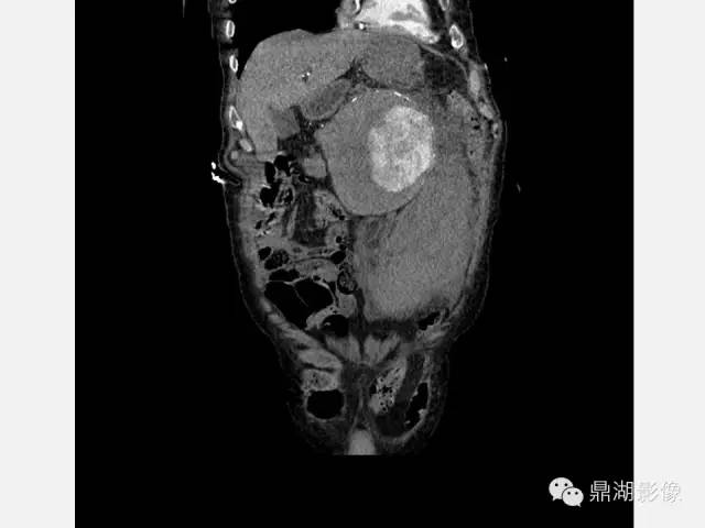 【病例】巨大腹主动脉瘤破裂1例CT影像表现