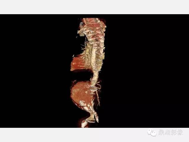 【病例】巨大腹主动脉瘤破裂1例CT影像表现