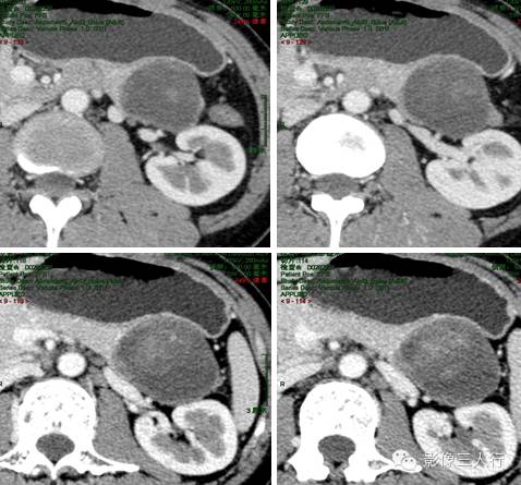 胰腺实性假乳头状瘤Solid Pseudopaillary Neoplasm