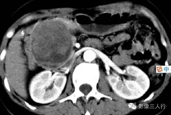 胰腺实性假乳头状瘤Solid Pseudopaillary Neoplasm