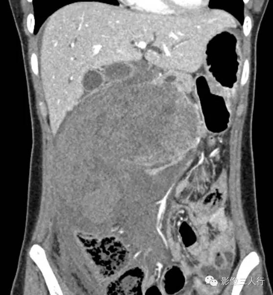 胰腺实性假乳头状瘤Solid Pseudopaillary Neoplasm