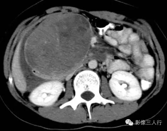 胰腺实性假乳头状瘤Solid Pseudopaillary Neoplasm