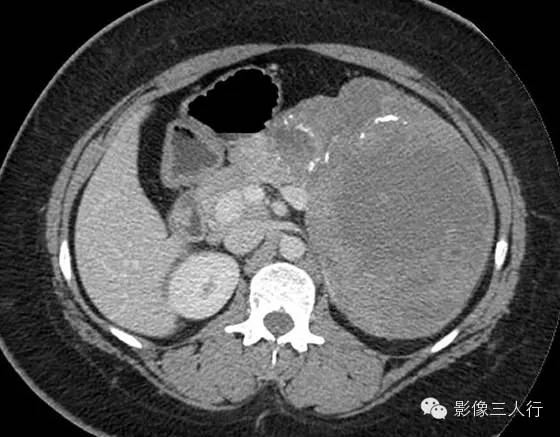 胰腺实性假乳头状瘤Solid Pseudopaillary Neoplasm