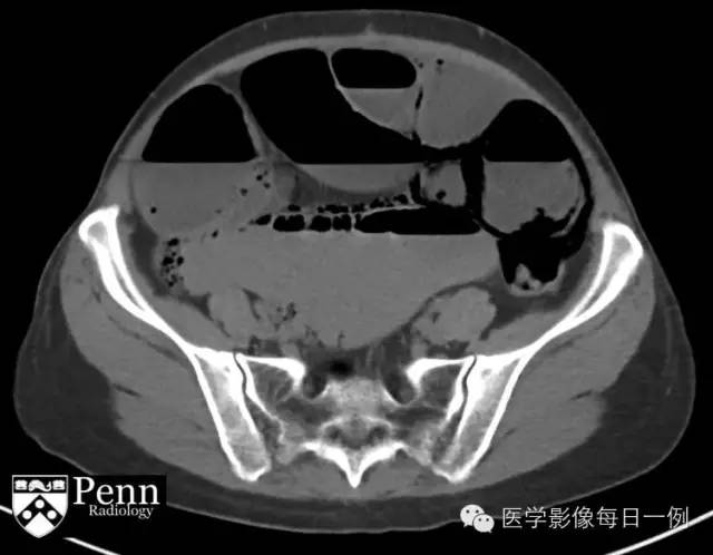 【病例】肠壁积气1例影像表现