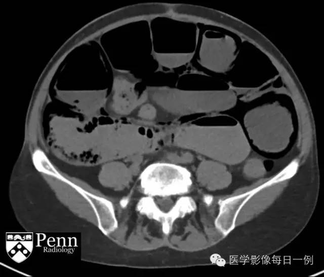 【病例】肠壁积气1例影像表现