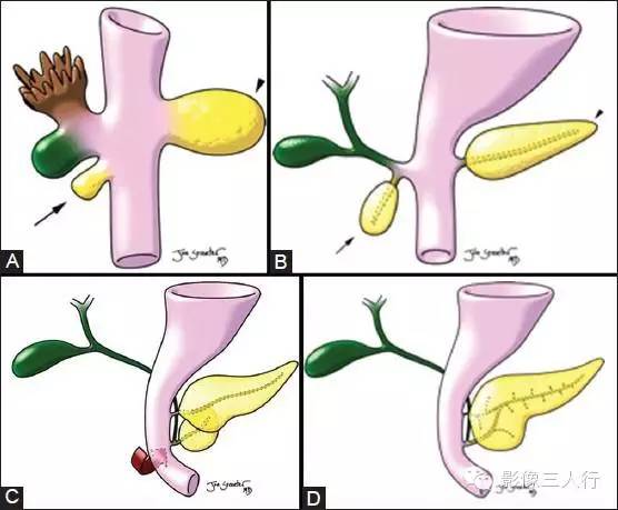 先天性背胰缺如 Dorsal pancreatic agenesis