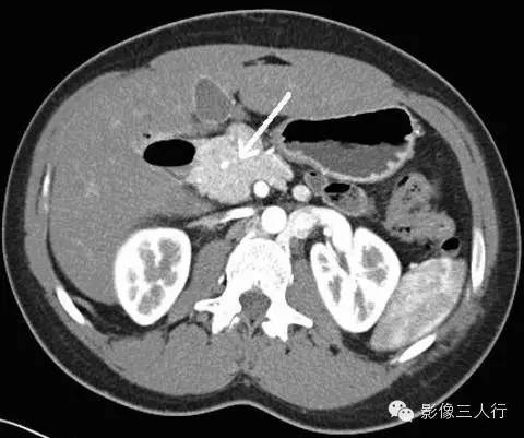 先天性背胰缺如 Dorsal pancreatic agenesis