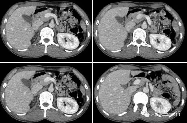 先天性背胰缺如 Dorsal pancreatic agenesis