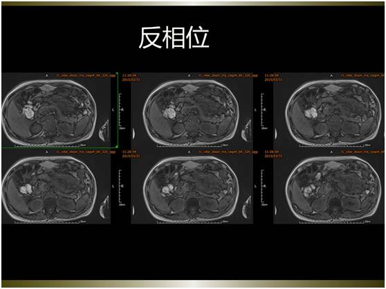 【病例】腹膜恶性间皮瘤1例MR影像表现
