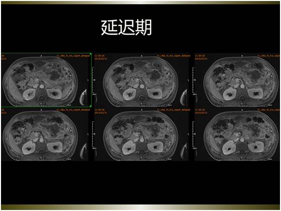 【病例】腹膜恶性间皮瘤1例MR影像表现