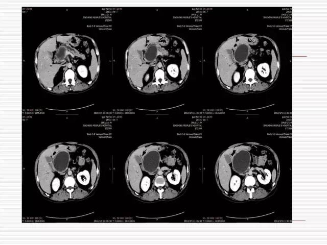 【病例】胰腺囊性病变6例CT影像表现与鉴别
