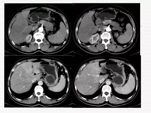 【病例】胰腺囊性病变6例CT影像表现与鉴别
