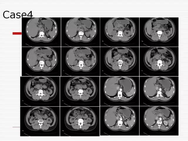 【病例】胰腺囊性病变6例CT影像表现与鉴别