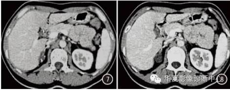 【病例】肾上腺囊性淋巴管瘤CT表现二例