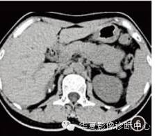 【病例】肾上腺囊性淋巴管瘤CT表现二例