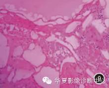 【病例】肾上腺囊性淋巴管瘤CT表现二例