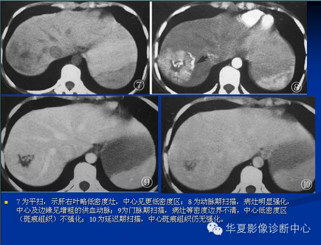 【PPT】局灶性结节增生的影像表现
