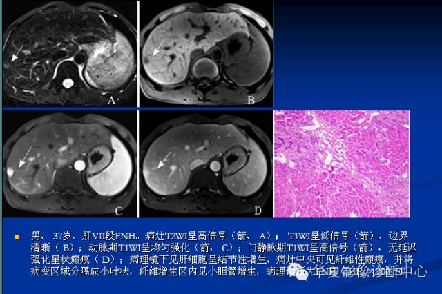 【PPT】局灶性结节增生的影像表现