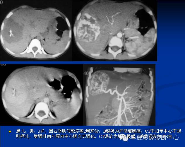 【PPT】局灶性结节增生的影像表现