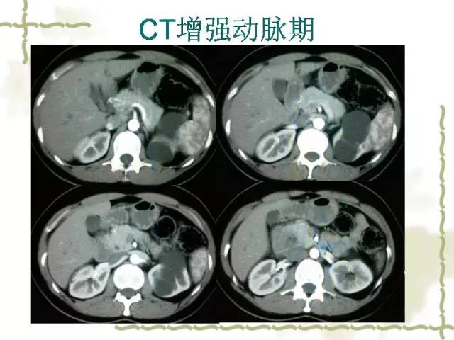 【病例】腹膜后平滑肌肉瘤1例CT影像表现