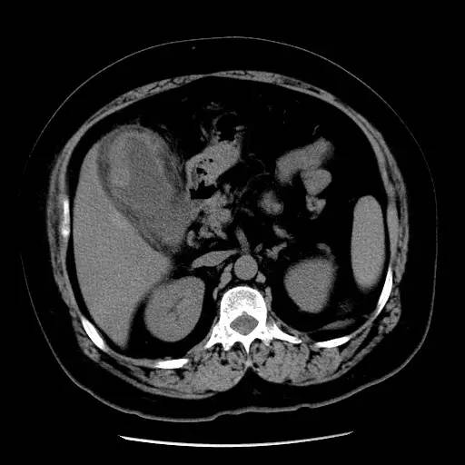 【病例】胆囊癌1例CT影像表现型