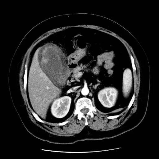 【病例】胆囊癌1例CT影像表现型