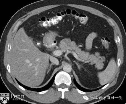 【病例】胰腺多囊浆液性囊腺瘤1例CT MR影像表现 【病例】胰腺多囊浆液性囊腺瘤1例CT MR影像表现