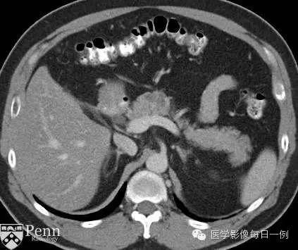 【病例】胰腺多囊浆液性囊腺瘤1例CT MR影像表现 【病例】胰腺多囊浆液性囊腺瘤1例CT MR影像表现