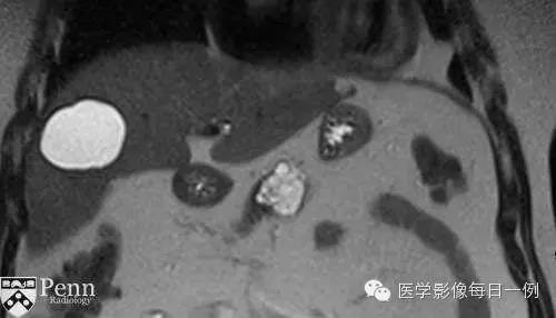 【病例】胰腺多囊浆液性囊腺瘤1例CT MR影像表现 【病例】胰腺多囊浆液性囊腺瘤1例CT MR影像表现